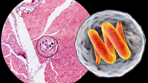 3D-Darstellung und mikroskopische Aufnahme (Querschnitt) einer Zyste im Muskel, die Trichinella spiralis enthält. Nematodenlarven-Zyste im Muskelgewebe, übertragen durch Verzehr von unzureichend erhitztem Fleisch. 3D-Darstellung und mikroskopische Aufnahme (Querschnitt) einer Zyste im Muskel, die Trichinella spiralis enthält. Nematodenlarven-Zyste im Muskelgewebe, übertragen durch Verzehr von unzureichend erhitztem Fleisch.