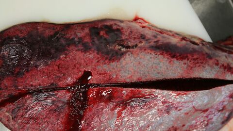 Milz: hochgradige Schwellung (gemischte Hyperplasie).